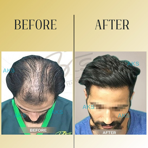 before after result